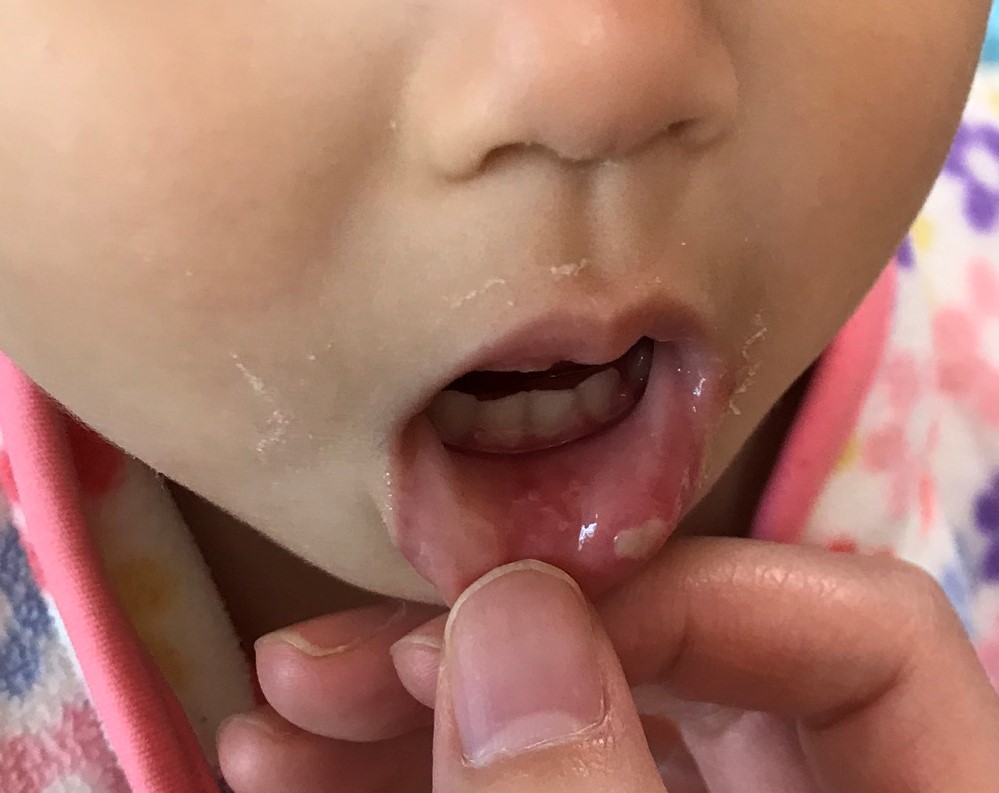 【ヘルペス性歯肉口内炎】高熱が続いた時の子供（幼児）の病気