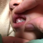 【ヘルペス性歯肉口内炎】高熱が続いた時の子供（幼児）の病気