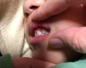 下の子から上の子へ感染したヘルペスウイルスのお話