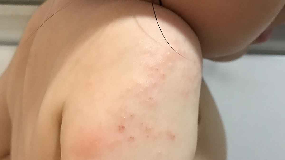 掻きむしった肩