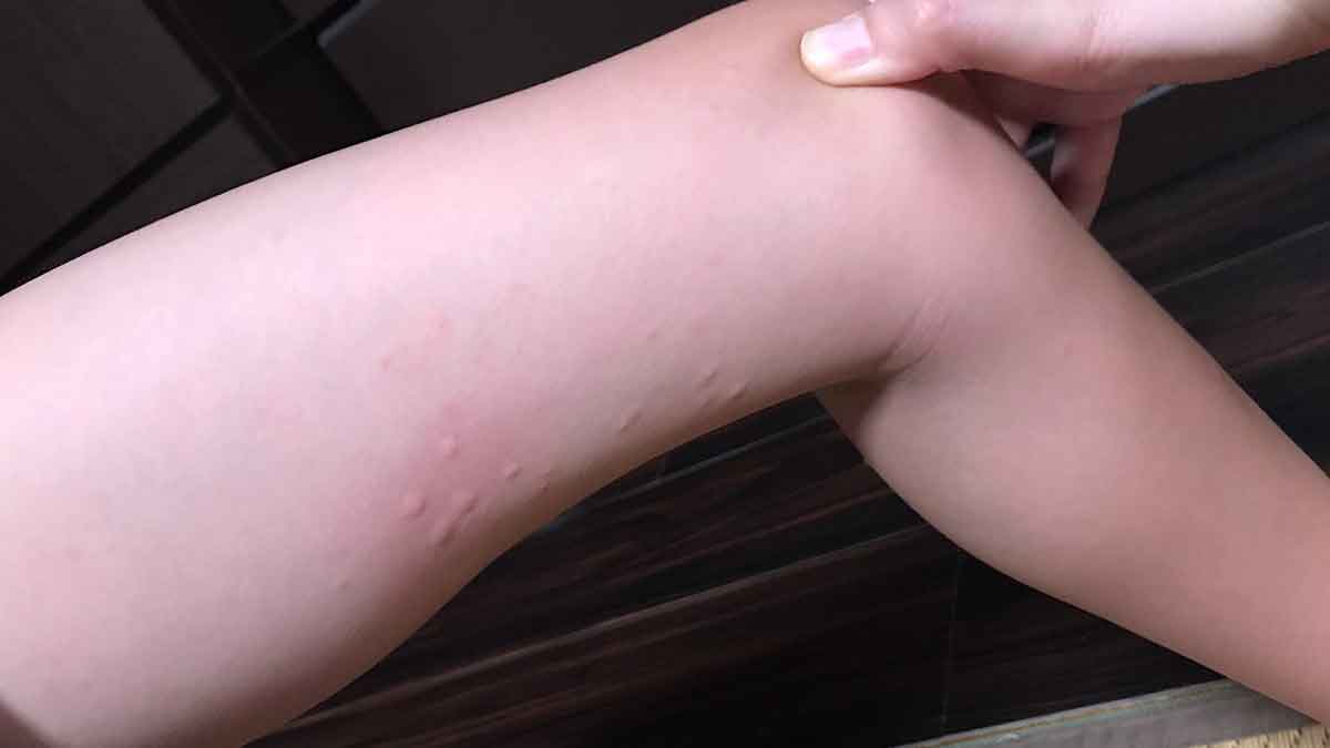 子供の足にできた蕁麻疹